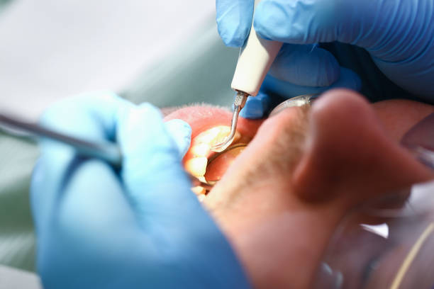 Best Emergency Tooth Extraction in Rossville, TN