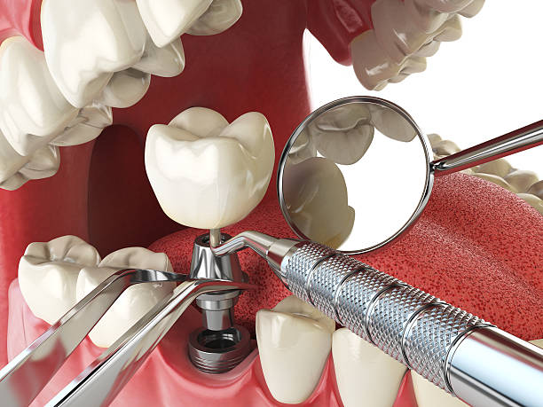 Best Emergency Tooth Extraction in Rossville, TN